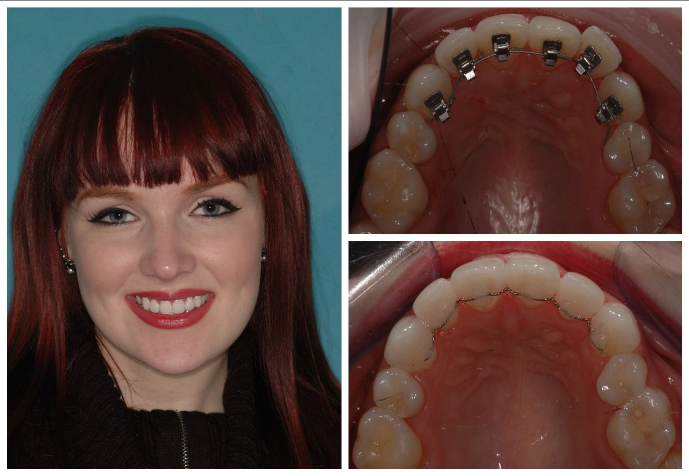 Cosmetic dentistry before and after photo