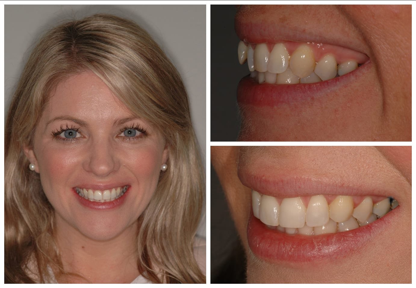 Cosmetic dentistry before and after photo