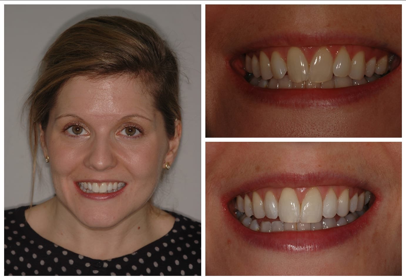 Cosmetic dentistry before and after photo