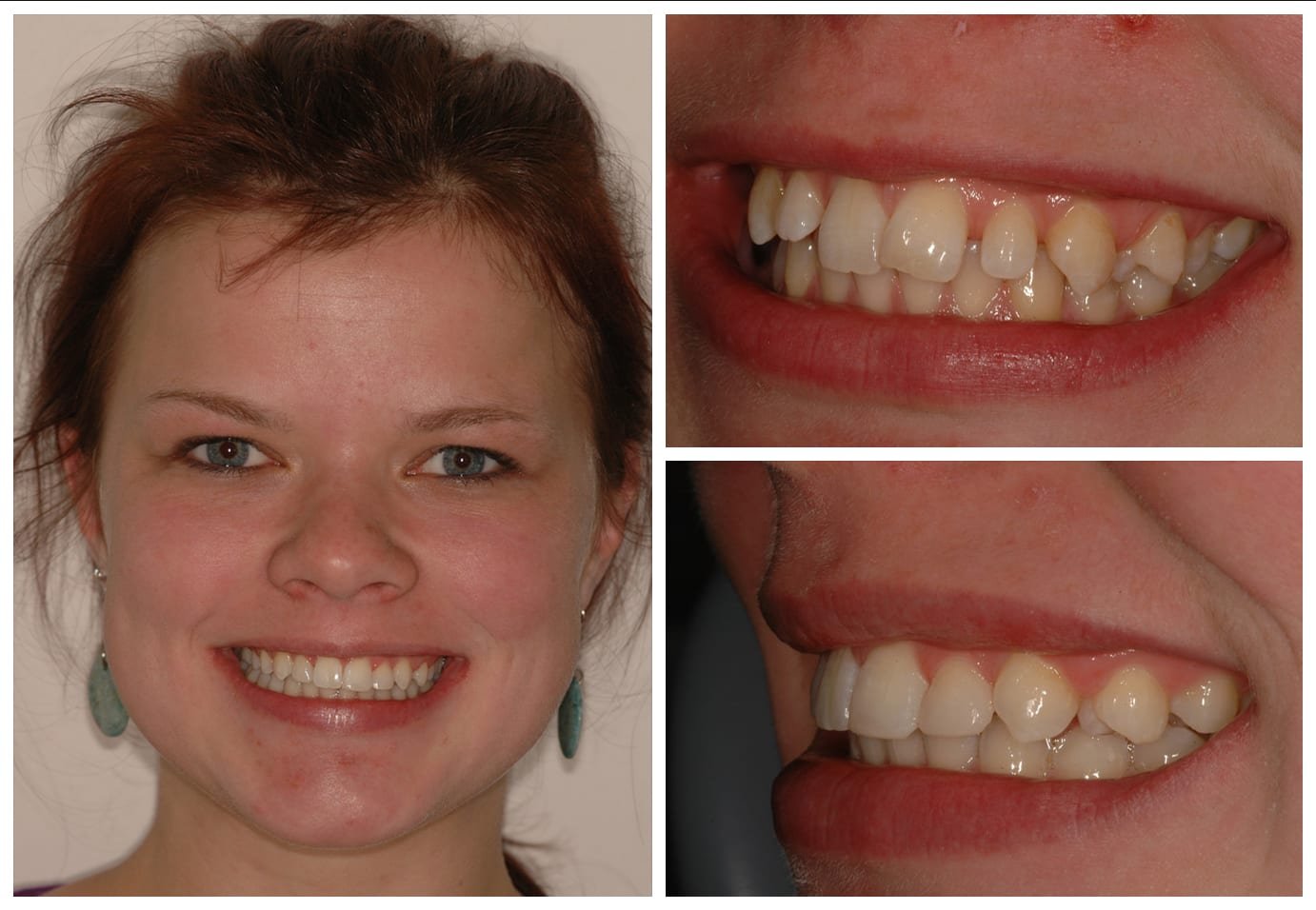 Cosmetic dentistry before and after photo