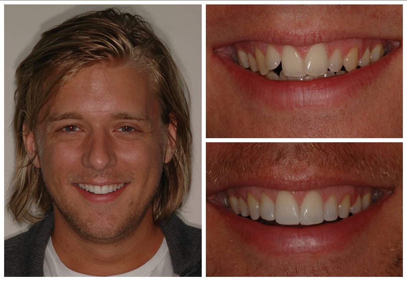 Cosmetic dentistry before and after photo
