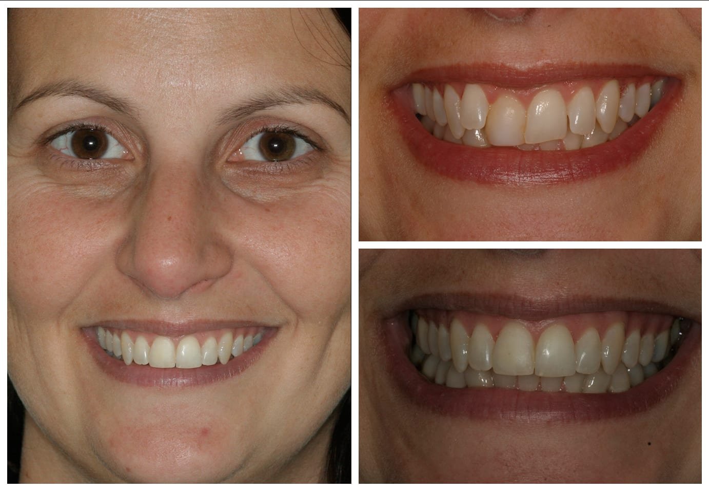 Cosmetic dentistry before and after photo
