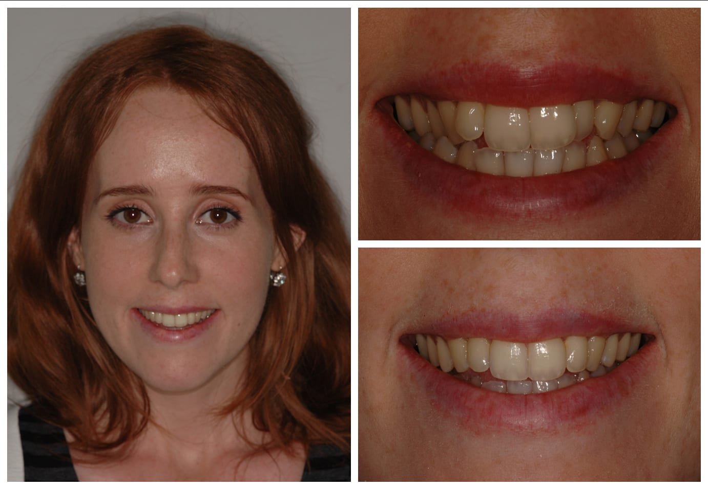 Cosmetic dentistry before and after photo