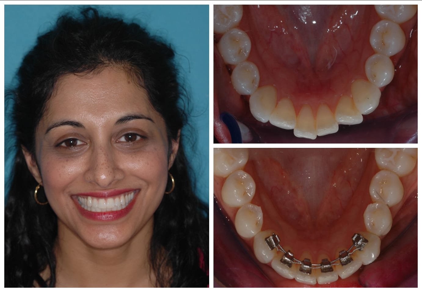 Before and after braces