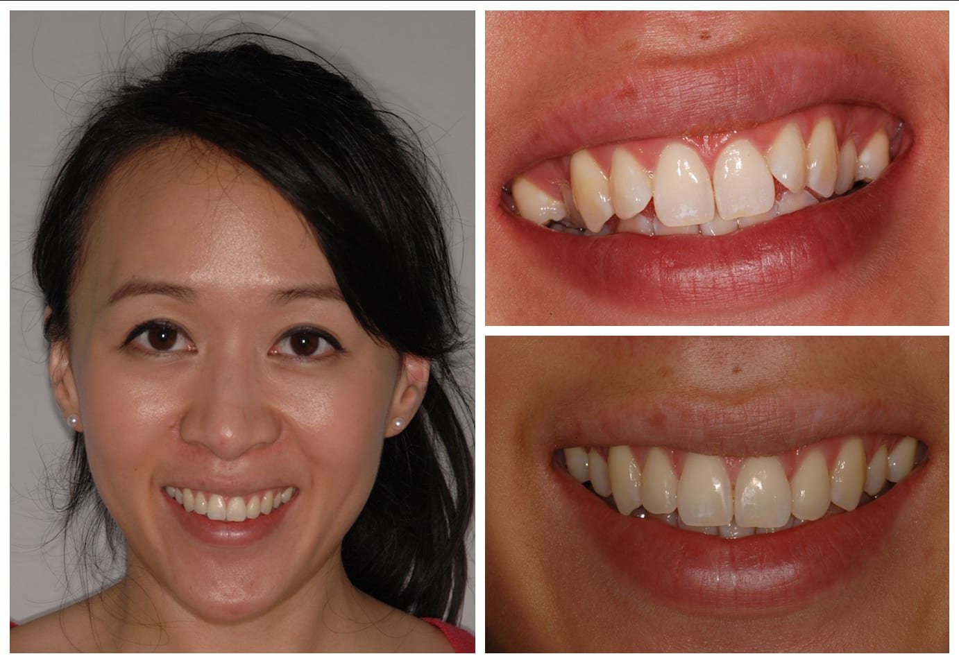 Cosmetic dentistry before and after photo