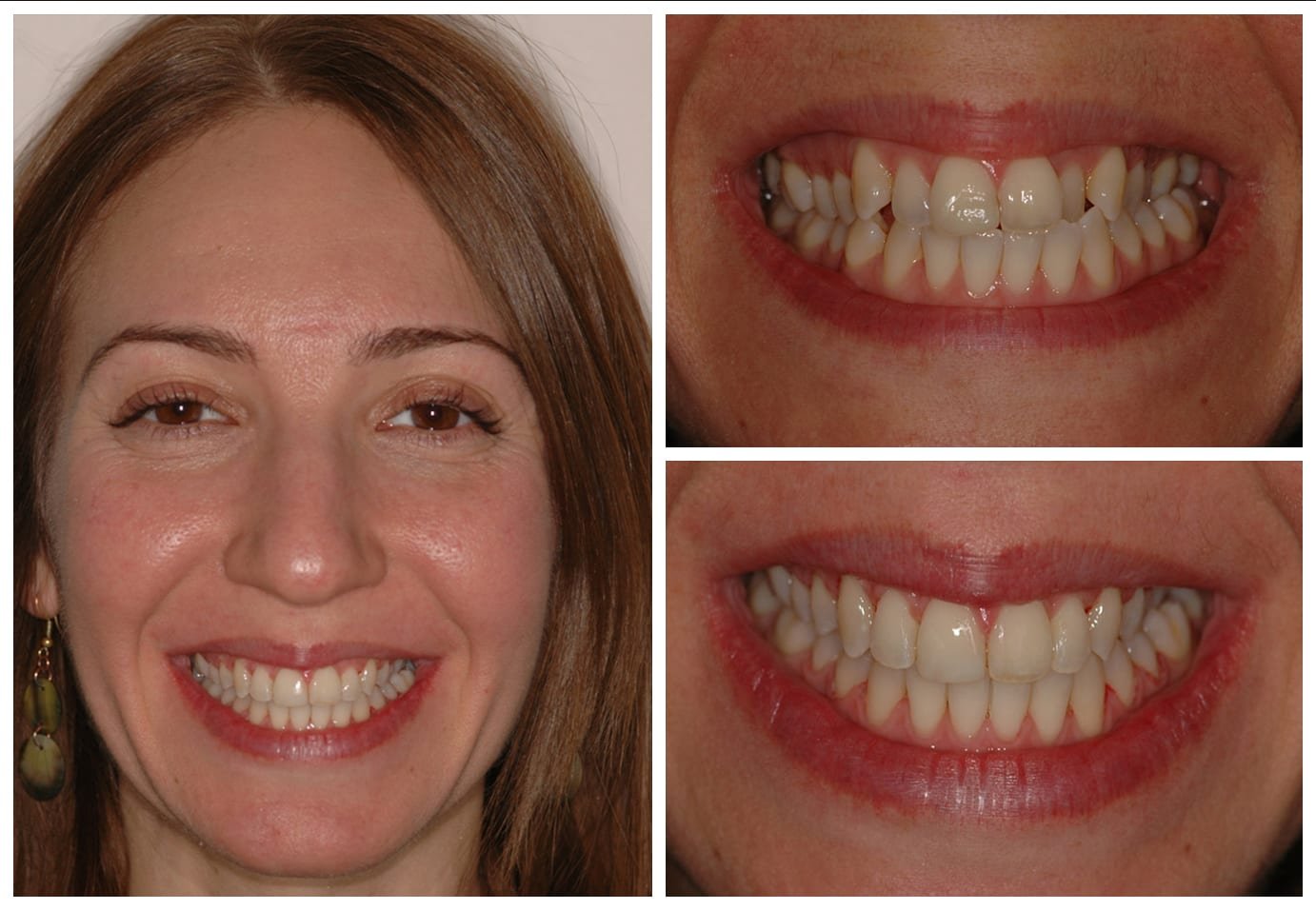 Cosmetic dentistry before and after photo