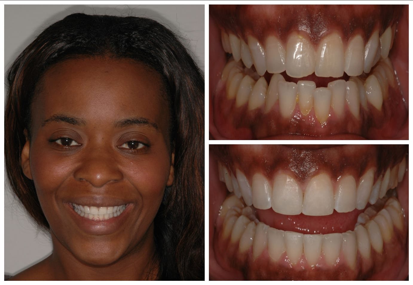 Cosmetic dentistry before and after photo