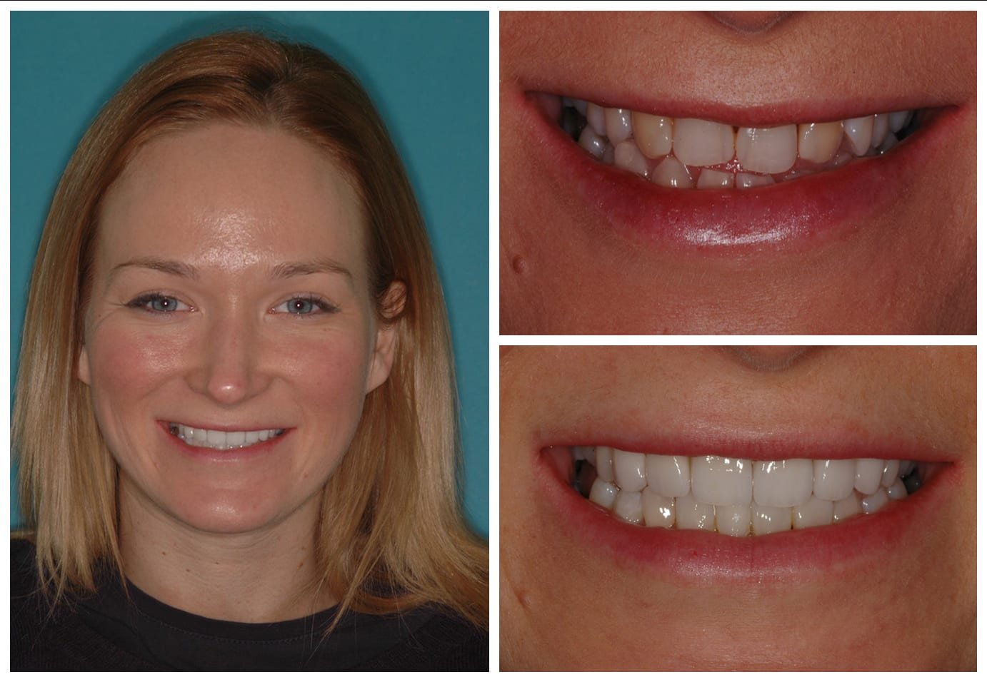 Before and after photo cosmetic dentistry