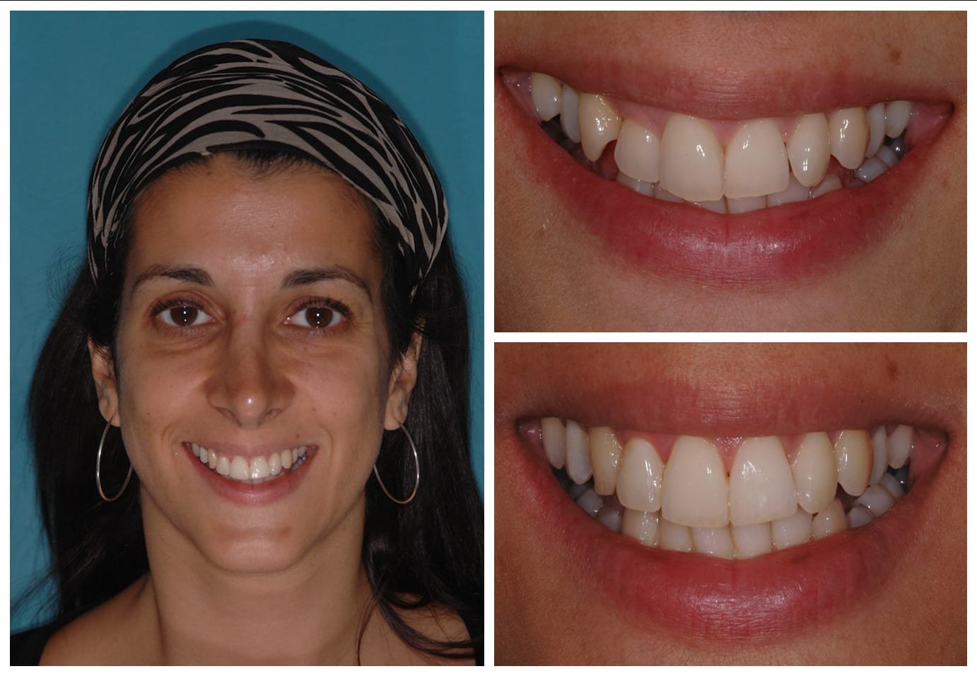 Before and after photo cosmetic dentistry