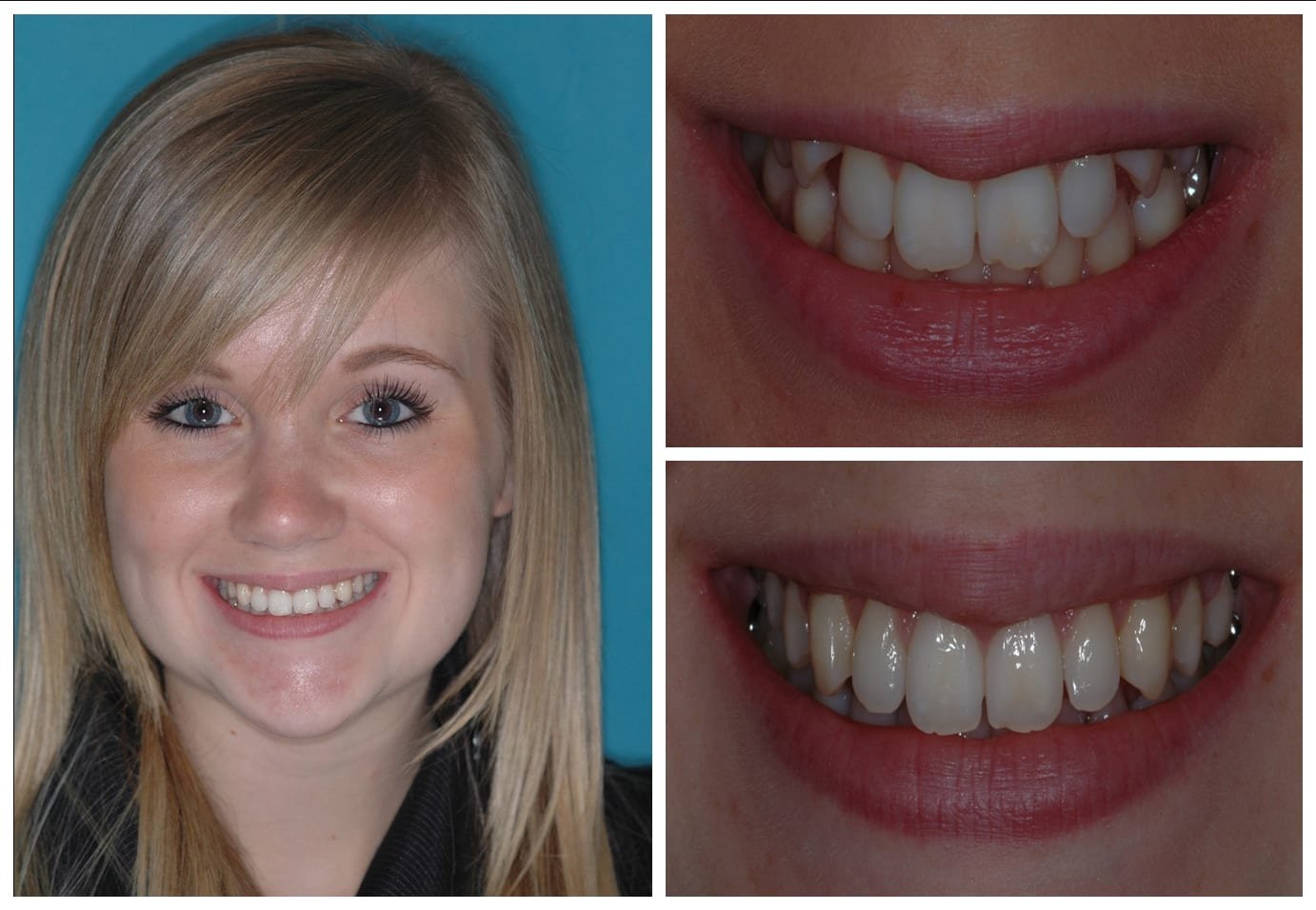 Before and after photo cosmetic dentistry