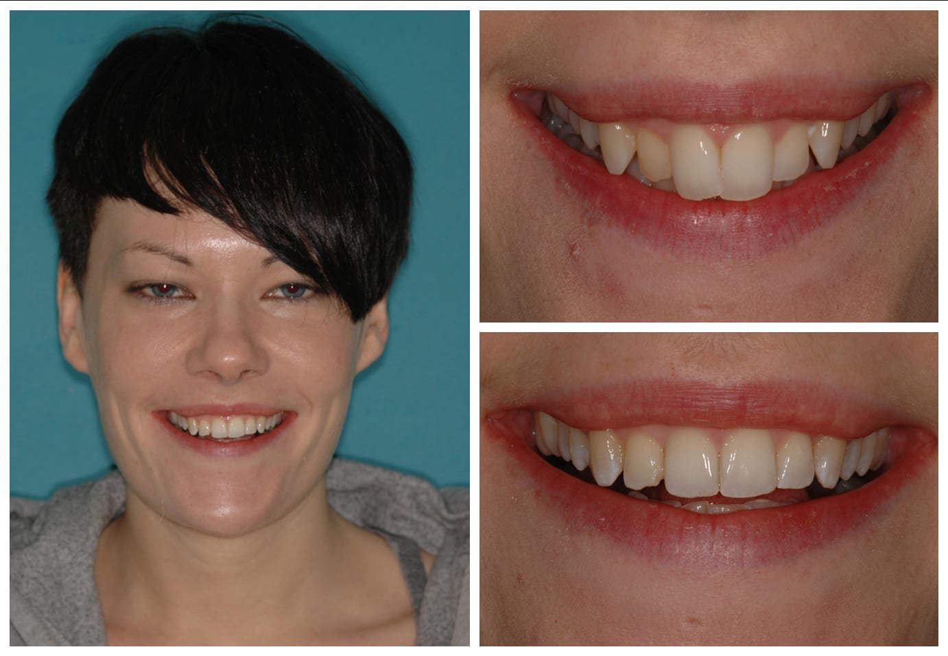 Before and after photo cosmetic dentistry