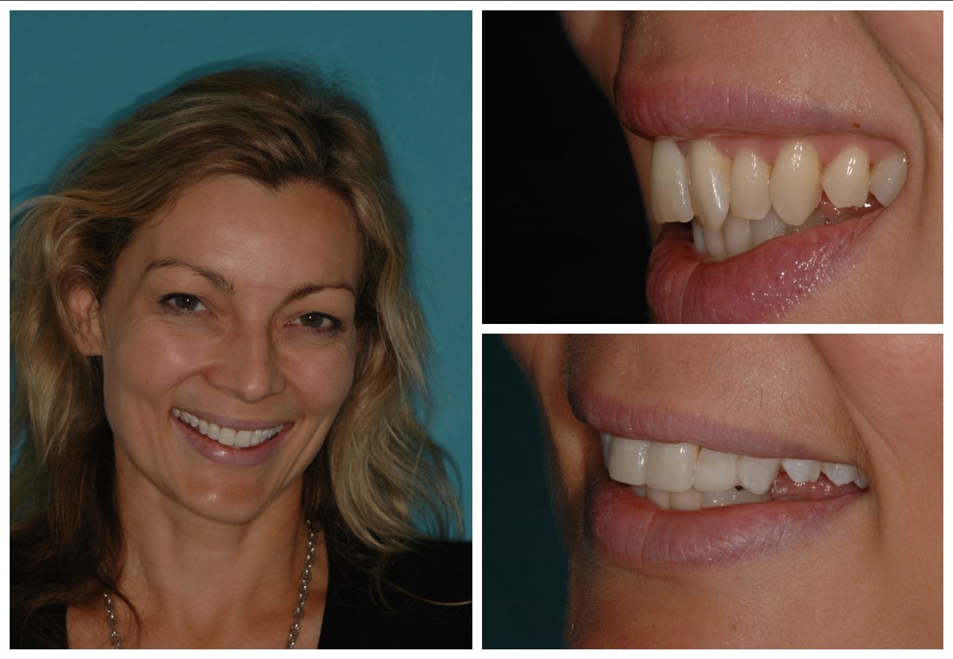 Before and after photo cosmetic dentistry