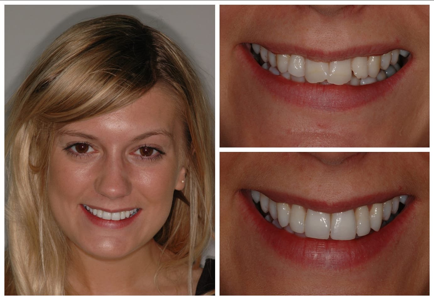 Before and after photo cosmetic dentistry