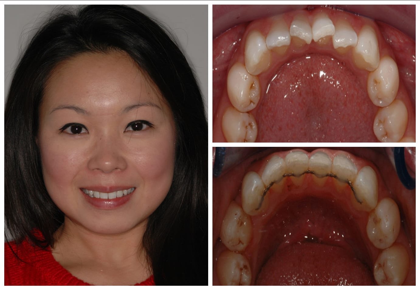 Before and after photo cosmetic dentistry
