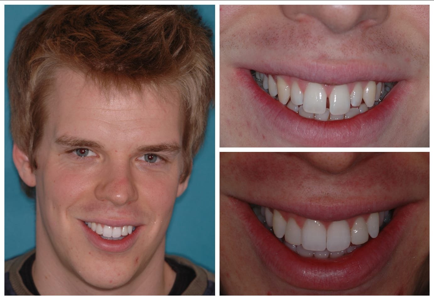 invis before and after image