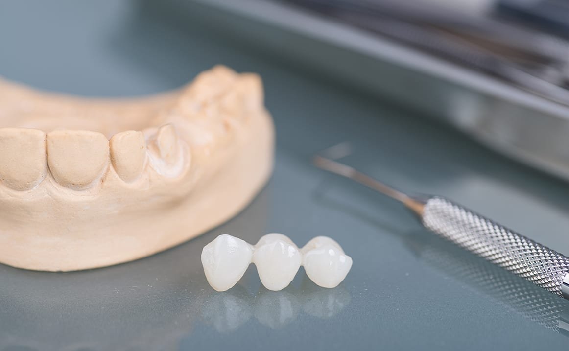 decayed or broken teeth