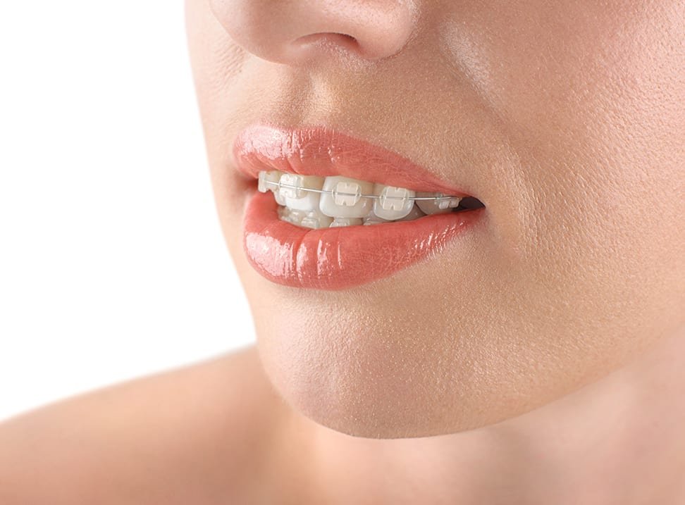 Standard fixed braces work wonders on crooked teeth