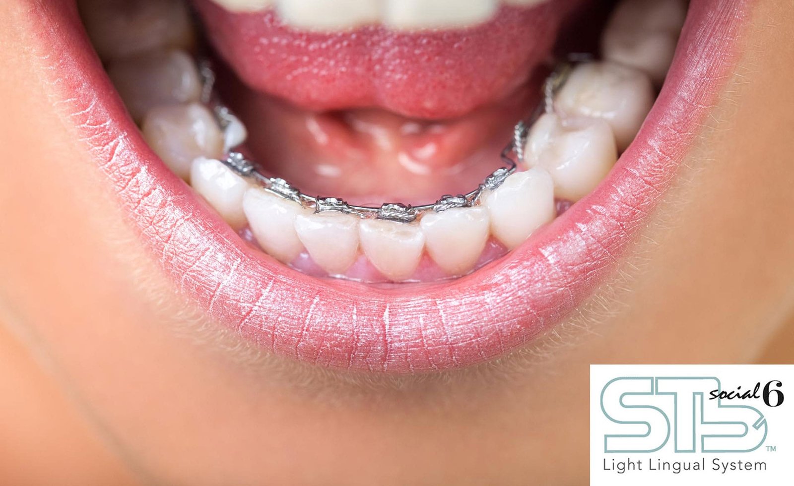 Lingual braces system