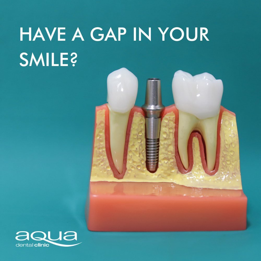 gap in smile