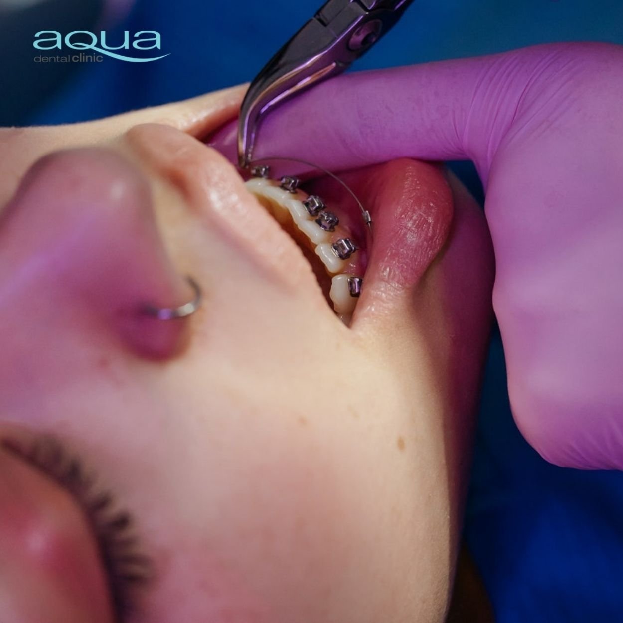 traditional braces thing of the past